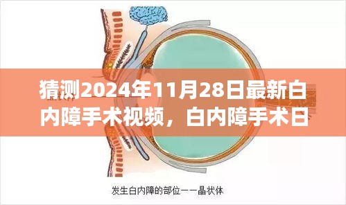 白內障手術最新進展揭秘,溫馨之旅中的小驚喜,白內障手術日精彩瞬間回顧(附最新視頻)