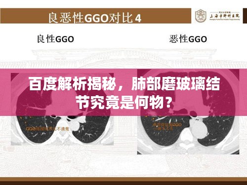 百度解析揭秘,肺部磨玻璃結節究竟是何物?